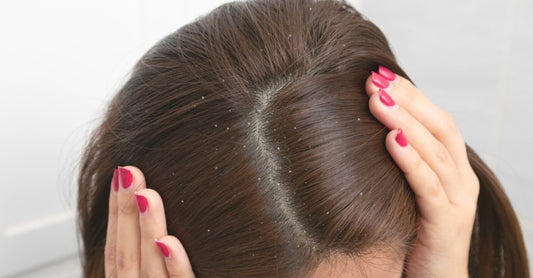 Why does dandruff occur in our hair? What precautions should we take?